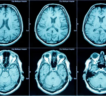 CT SCan CT SCan