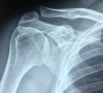Xray Xray