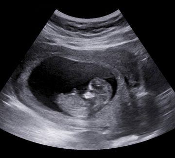 ultrasound-compressed ultrasound-compressed